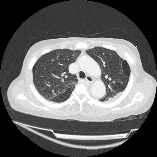 ct_chest_anemia_08